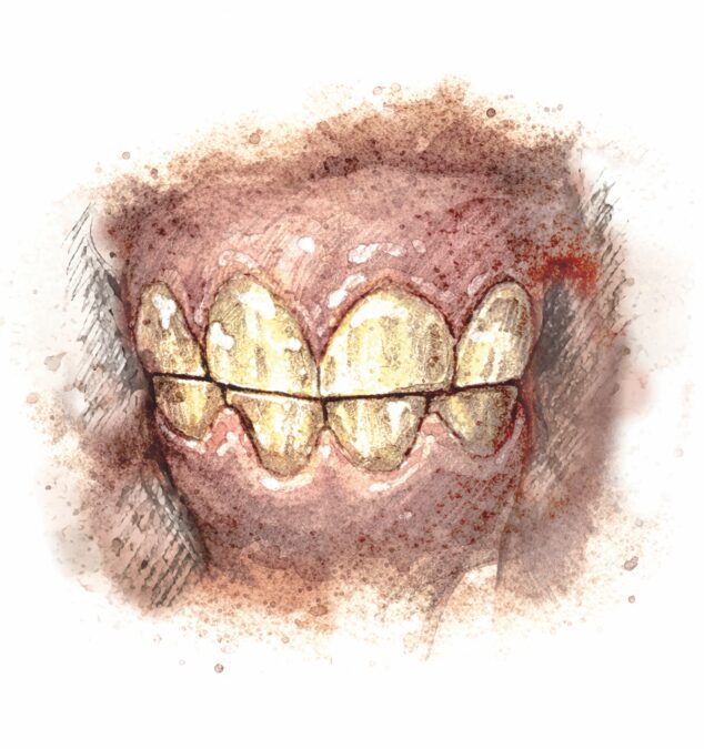 All deciduous ("baby") incisors